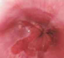 Gastroezofagealna refluksna bolezen: zdravljenje, simptomi, vzroki, simptomi