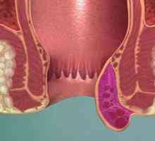 Hemorrhoidal tromboza: faza, simptomi in zdravljenje