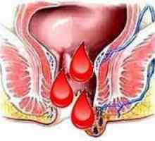 Hemoroidi med menstruacijo, zakaj se poslabša pred njimi?