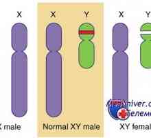 Genetske motnje spolnih žlez. Geni sry, WT1 in sindromi Fraser in Denis-dresha