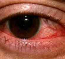 Herpetičnega vnetja roženice oči: zdravljenje, preprečevanje, simptomi, vzroki