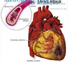 Miokardni infarkt. Vzroki smrti pri miokardnem infarktu