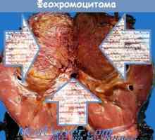 Hyperfunction nadledvične sredice (feokromocitoma) morfologijo in patološko anatomijo
