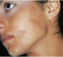 Hiperpigmentacija kože: zdravljenje, vzroki, preprečevanje