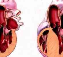 Hipertrofična kardiomiopatija: Zdravljenje, simptomi