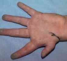 Hipoplaziji prvih prstov