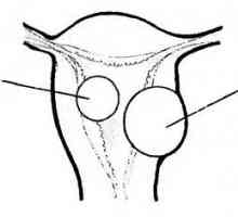 Histeroskopija v diagnozo in zdravljenje maternice fibroids