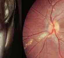 Očesni toksokariaza, simptomi in zdravljenje pri odraslih