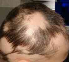 Alopecia areata: Zdravljenje, vzroki, simptomi