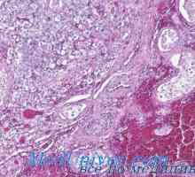 Gormonalnoaktivnye testisov tumorjev leydigomy