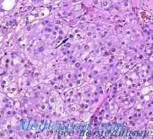 Gormonalnoaktivnye tumorja nadledvične skorje
