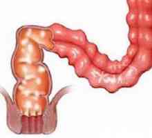 Granulomatozni kolitisa in enteritis