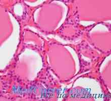 Granulomatozne tiroiditis de Quervain je morfologija, patološka anatomija