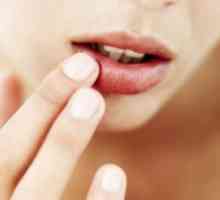 Heilitis na ustnicah, zdravljenje, simptomi, vzroki