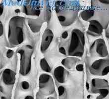 Chondromatosis kosti Ollier bolezni. Osteohondralni exostoses novorojenčki