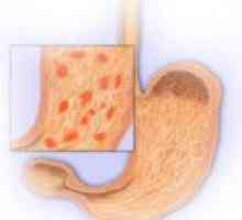 Kronični erozivni gastritis, njeni simptomi in pomoč prehrana pri zdravljenju