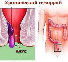 Kronične (konstanta), notranji in zunanji hemoroidi