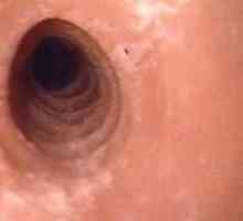 Infekcija (postherpetična) ezofagitis