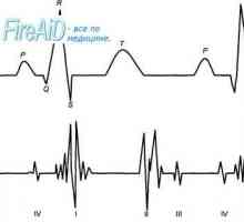 Srce se sliši. Prvi (sistolični) srce zvok. Drugi (diastolični) srce zvok. Phonocardiogram.