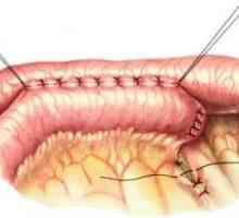 Spreminjanje anatomijo gastrointestinalnega trakta, ki je posledica operacije. anastomoz