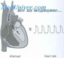 Povečanje srčnega proizvodnje. miokardni hipertrofija