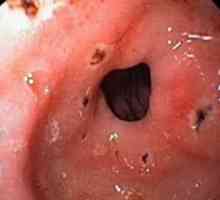 Ulcerozni gastroduodenitis