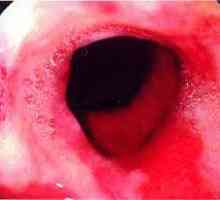 Ulcerozni ezofagitis požiralnika