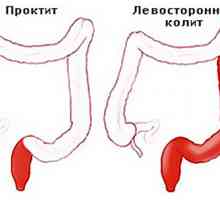 Ulcerozni kolitis je oblika distalnega