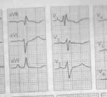 EKG: levo atrijska širitev