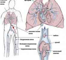 Embolija in tromboza arterij, zdravljenje