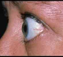 Endokrina oftalmopatija: zdravljenje, simptomi, diagnostika, klasifikacija