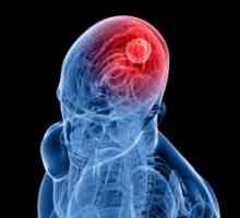 Epiduralna hematom na možganih: so simptomi, zdravljenje, posledice