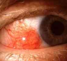 Episkleritis oči: zdravljenje, simptomi, vzroki