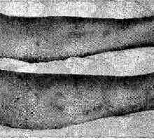 Nodozni eritem. klinična slika