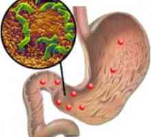 Erozijski gastritis in Helicobacter pylori