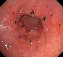 Erozijski gastritis z lezije (atrofija) antruma