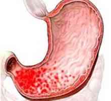 Erozivni kronični kataralni osrednja površinski gastritis
