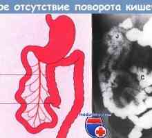 Faze razvoja črevesja. Vrtenje (namaz) fetalni črevesa