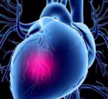 Kardiogeni šok: zdravljenje, simptomi, vzroki, simptomi