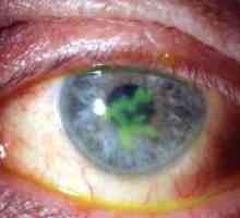 Keratitis oči: zdravljenje, simptomi, vzroki, simptomi