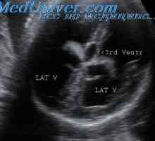 Klasifikacija fetalnih anomalij. UZI označevalci razvojnih nepravilnosti