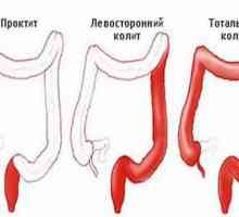 Kolitis in gastritis