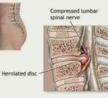 Kompresijo hrbtenjače (sindrom): Simptomi, Zdravljenje