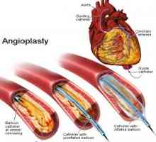 Koronarno angioplastiko