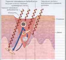 Obsevanja brazgotin. Učinek na celjenje ran