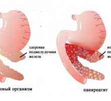 Pankreatitis povzročene z zdravili