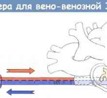 Postopek veno-vensko kateterizacijo za zunajtelesni membranski oksigenaciji (ECMO)