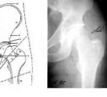 Načini rentgenska diagnostika: X-žarki kolčnega sklepa