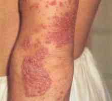 Miniatlas: kožne bolezni spremlja srbenje