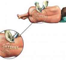 Anestezijo in epiduralne anestezije med operacijo odstraniti hemoroide